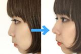 鼻が高くなる!?“鼻プチ”の効果がどれほどなのか試してみた