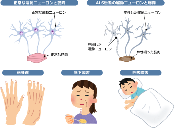 脊髄性筋萎縮症と筋ジストロフィーの症状は何ですか?