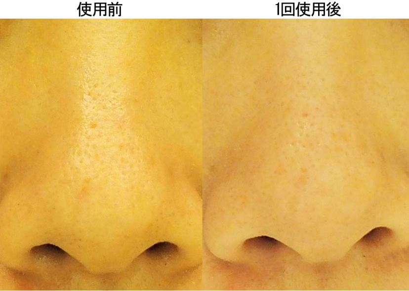 パナソニック「角栓クリア」でプツプツ“いちご鼻”は解消できるか パナソニック「角栓クリア」でプツプツ“いちご鼻”は解消できるか