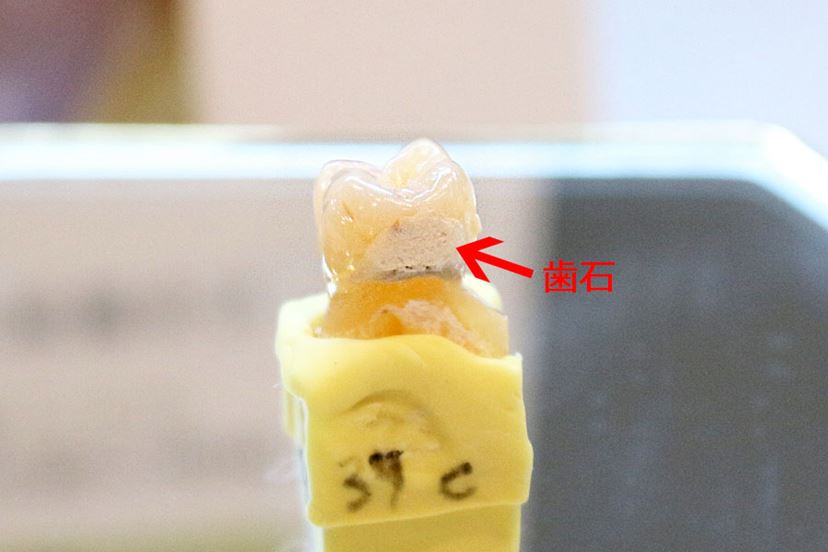 RF（ラジオ波）で歯を白くする電動歯ブラシ「シルキン ウェイブ